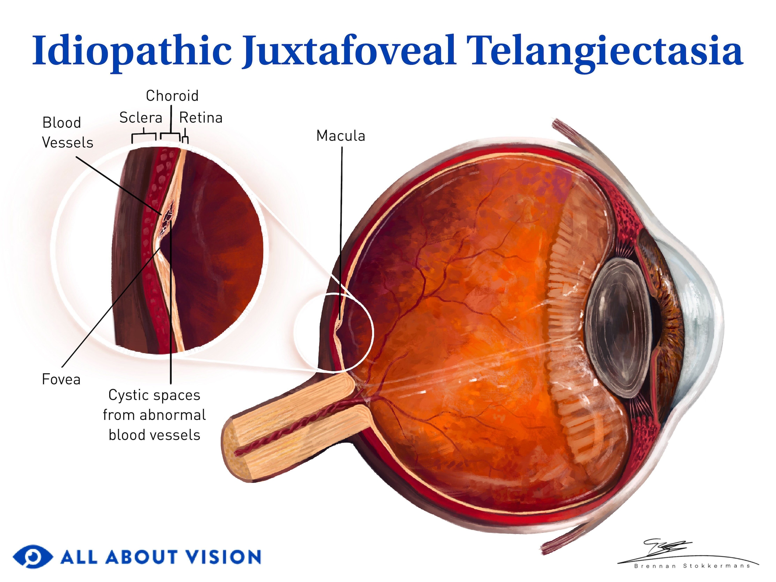 Idiopathic juxtafoveal telangiectasia