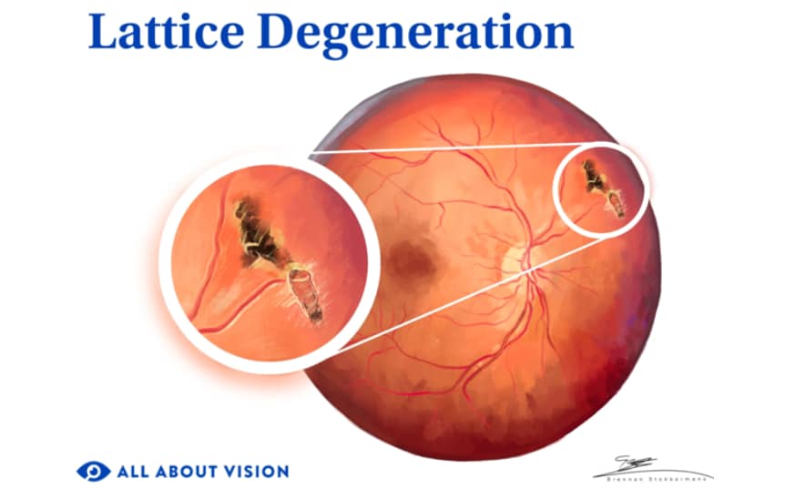 Lattice degeneration of the retina Lattice degeneration of the retina