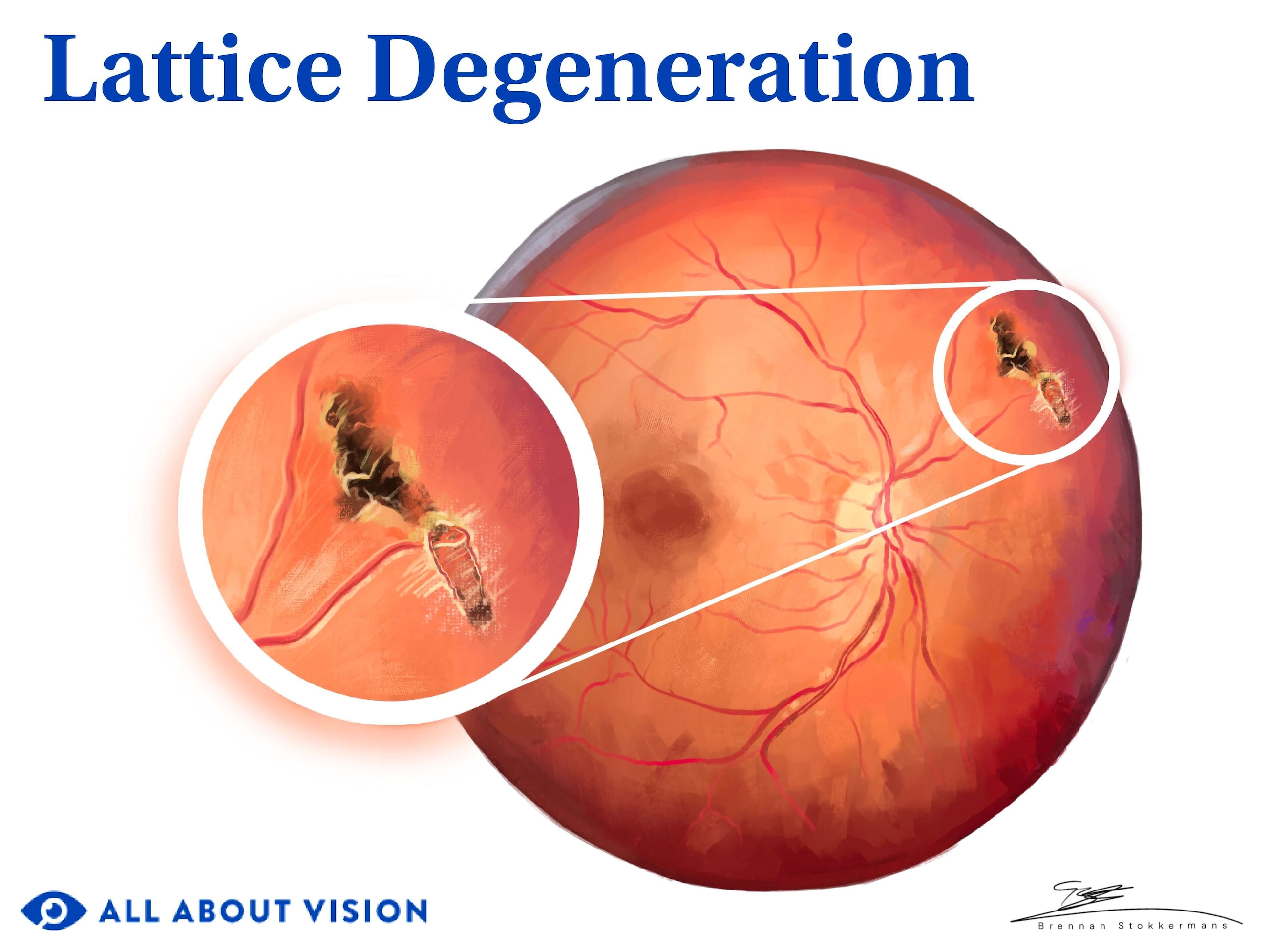 Lattice degeneration of the retina