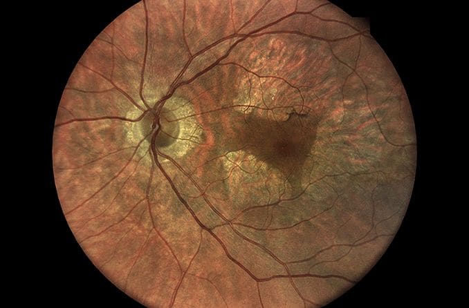 Macular Dystrophy: How This Rare Eye Disease Causes Blindness Macular Dystrophy: How This Rare Eye Disease Causes Blindness