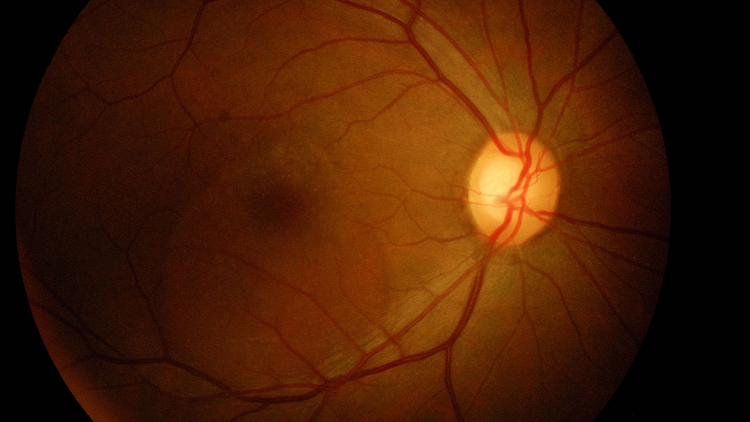 real image of a macular hole real image of a macular hole