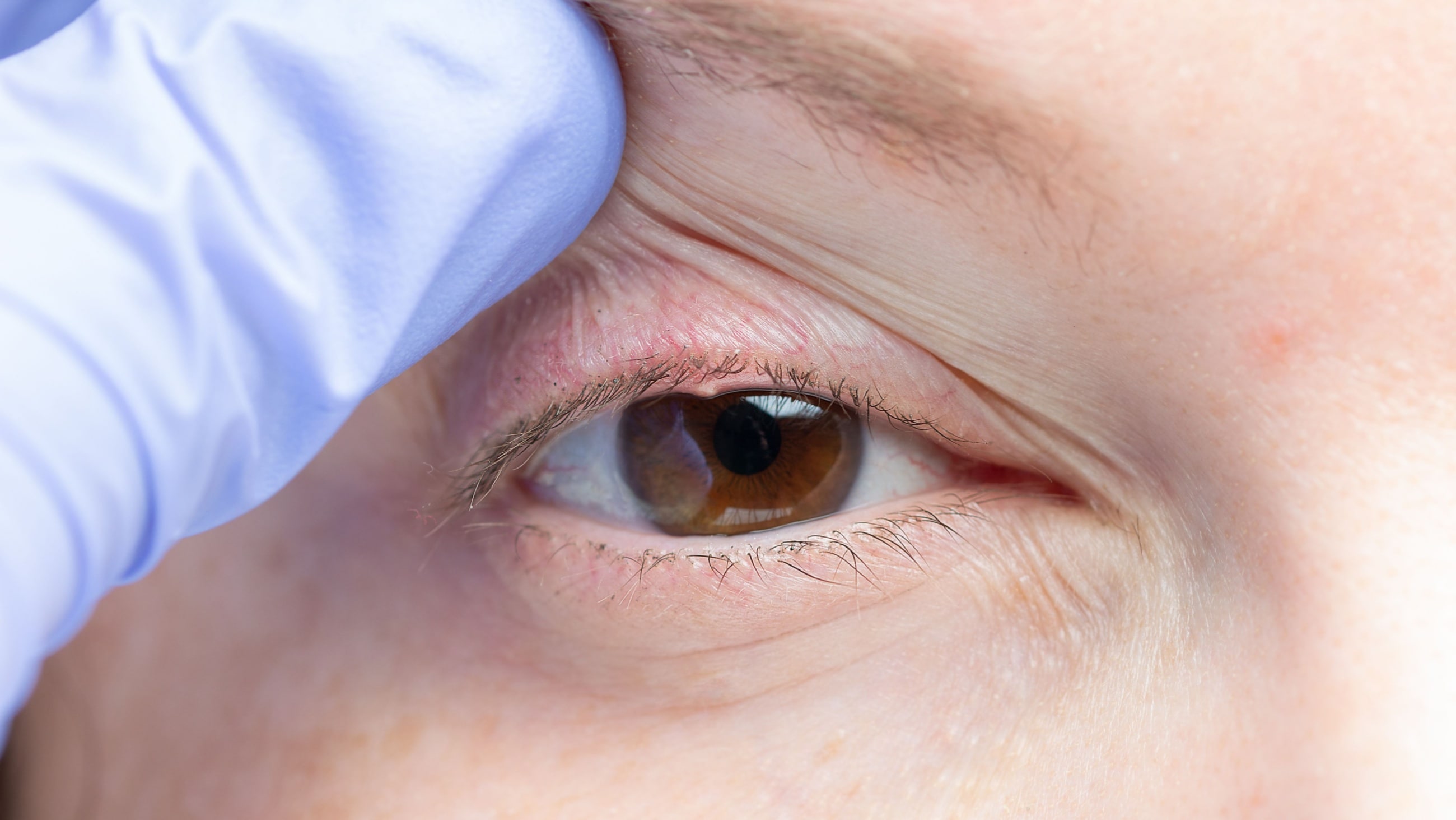 Meibomian gland dysfunction Meibomian gland dysfunction