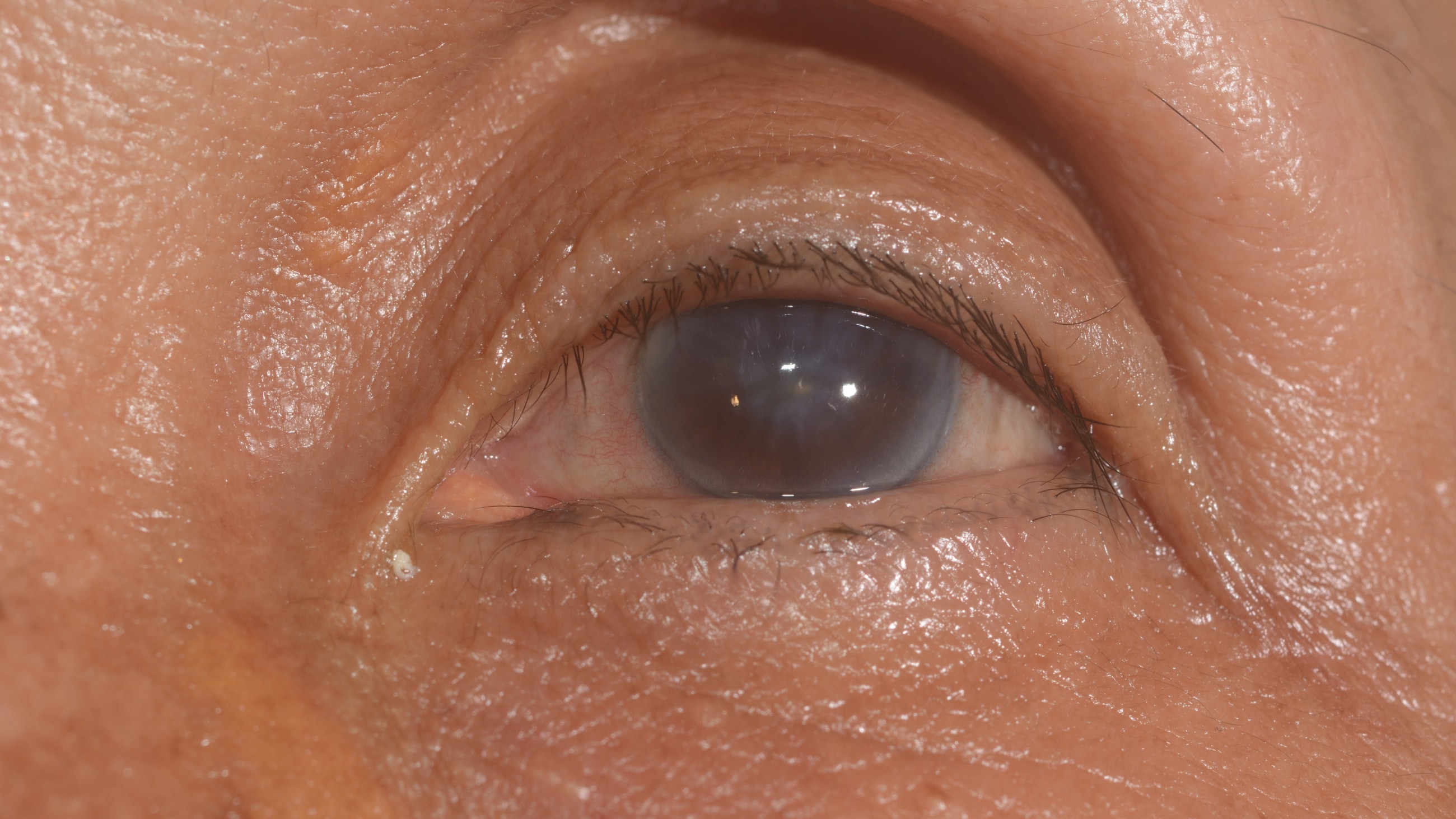 Corneal edema: Causes, symptoms and treatment Corneal edema: Causes, symptoms and treatment