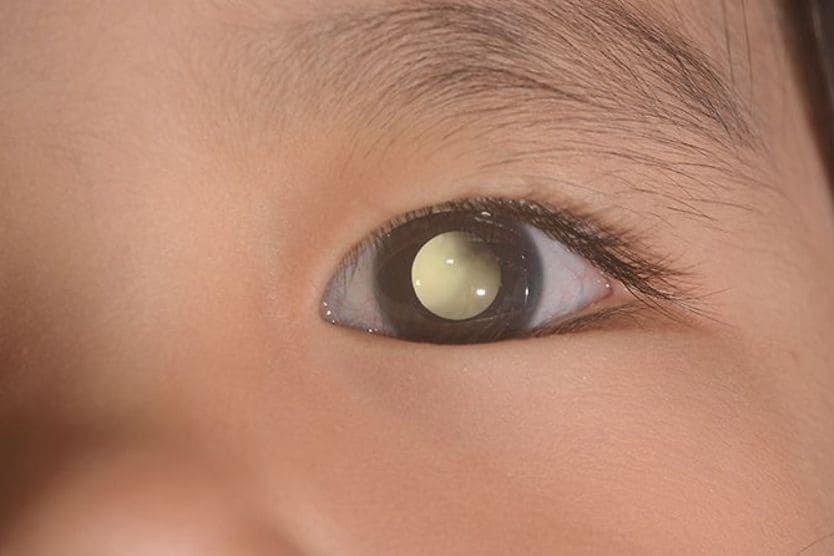 closeup of a child's eye with leukocoria