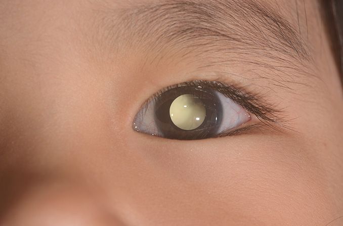 Leukocoria (white pupil) in infants, children and adults