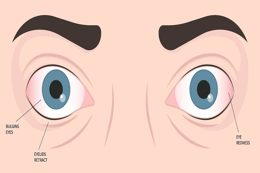 Characteristics of orbital pseudotumor include bulging eyes, eye redness, and retracted eyelids. Characteristics of orbital pseudotumor include bulging eyes, eye redness, and retracted eyelids.