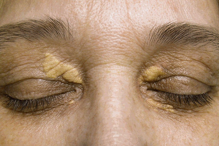 closeup of eyes with xanthelasma