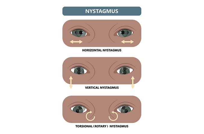 Nystagmus