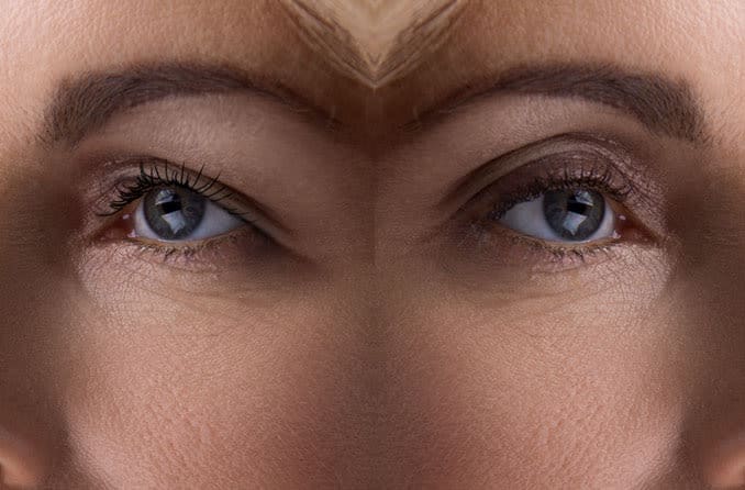 What causes drooping eyelids? What causes drooping eyelids?
