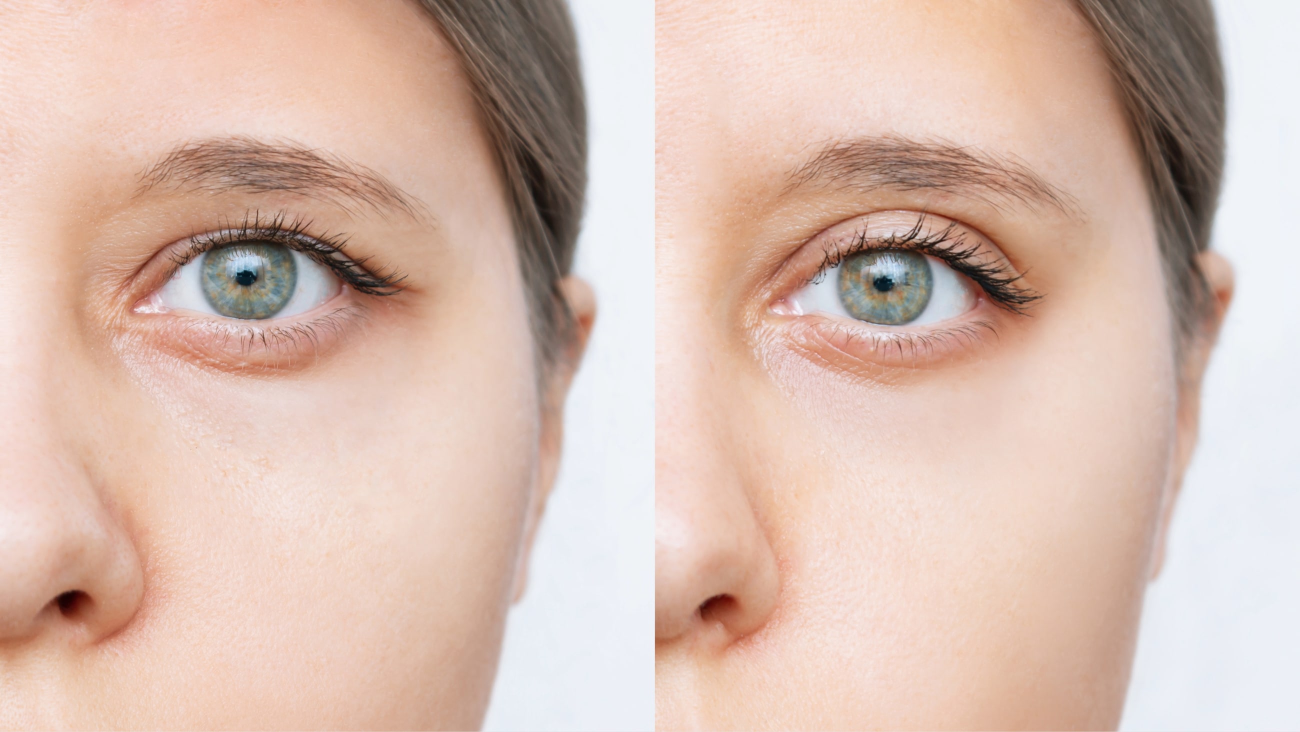What causes drooping eyelids? What causes drooping eyelids?