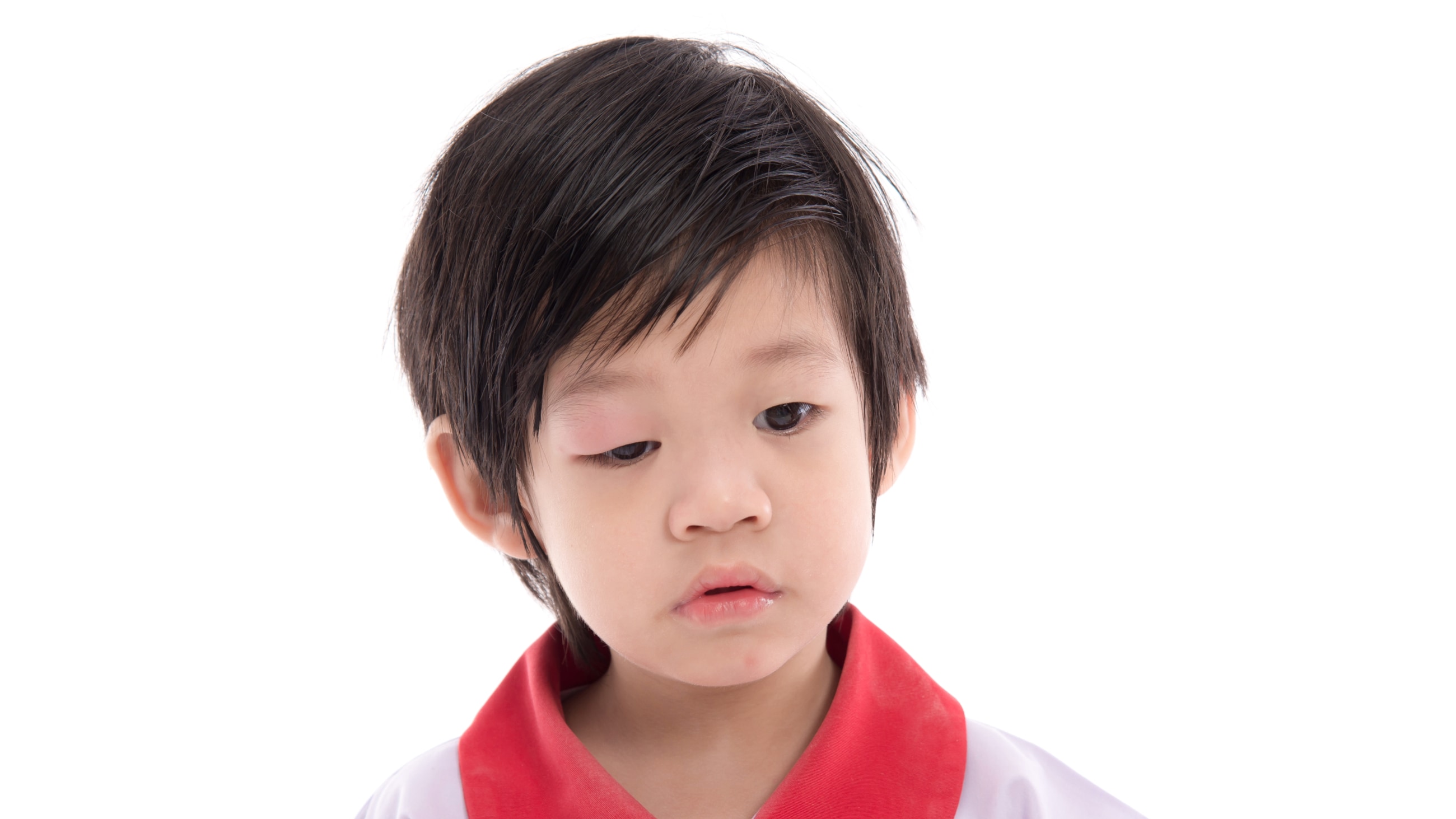 Symptoms of ptosis Symptoms of ptosis
