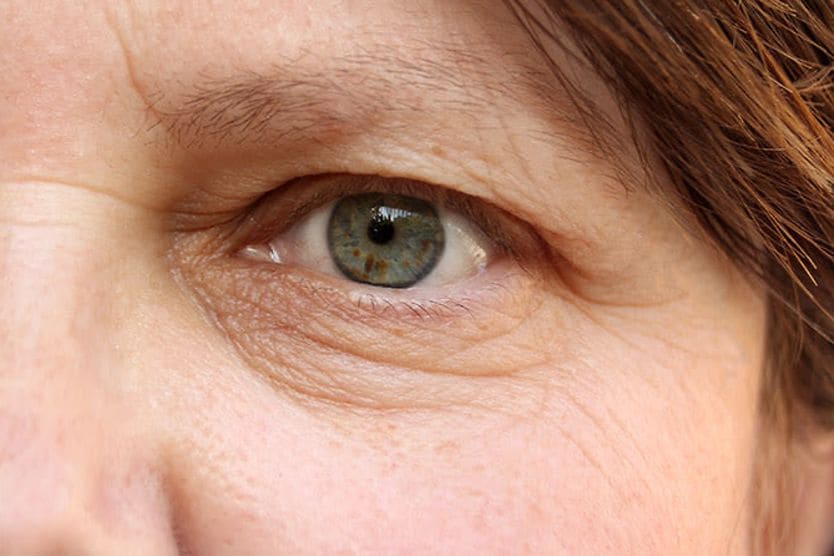 closeup of a woman with droopy eyelid (ptosis)