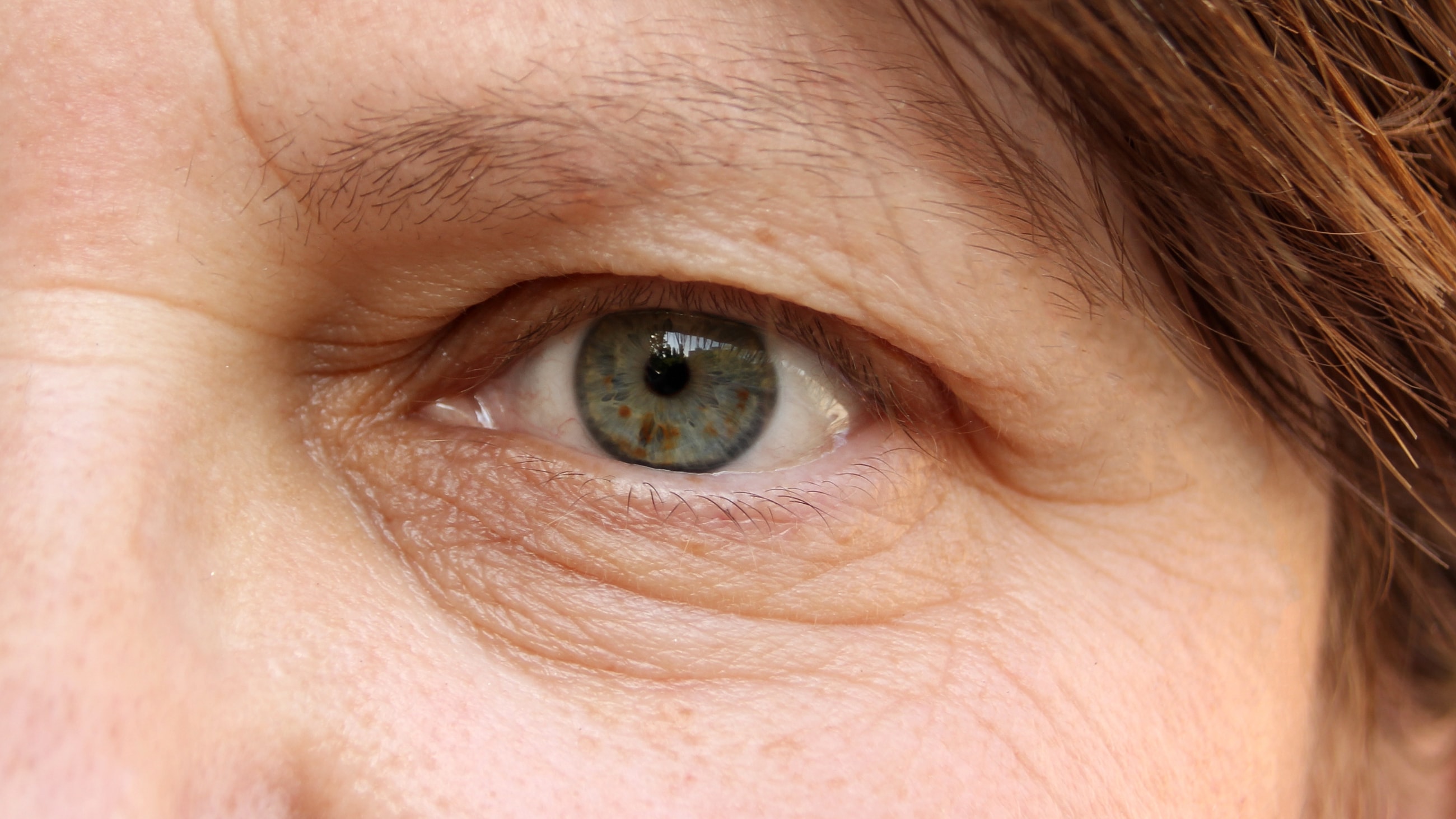 Types of ptosis Types of ptosis
