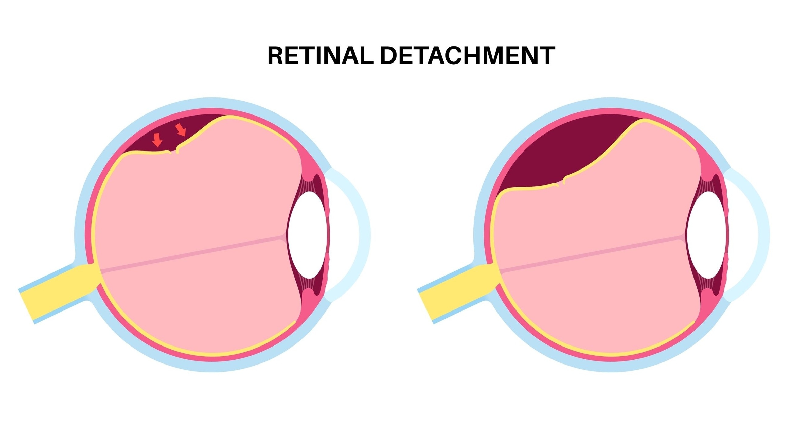 Retinal Detachment illustration Retinal Detachment illustration