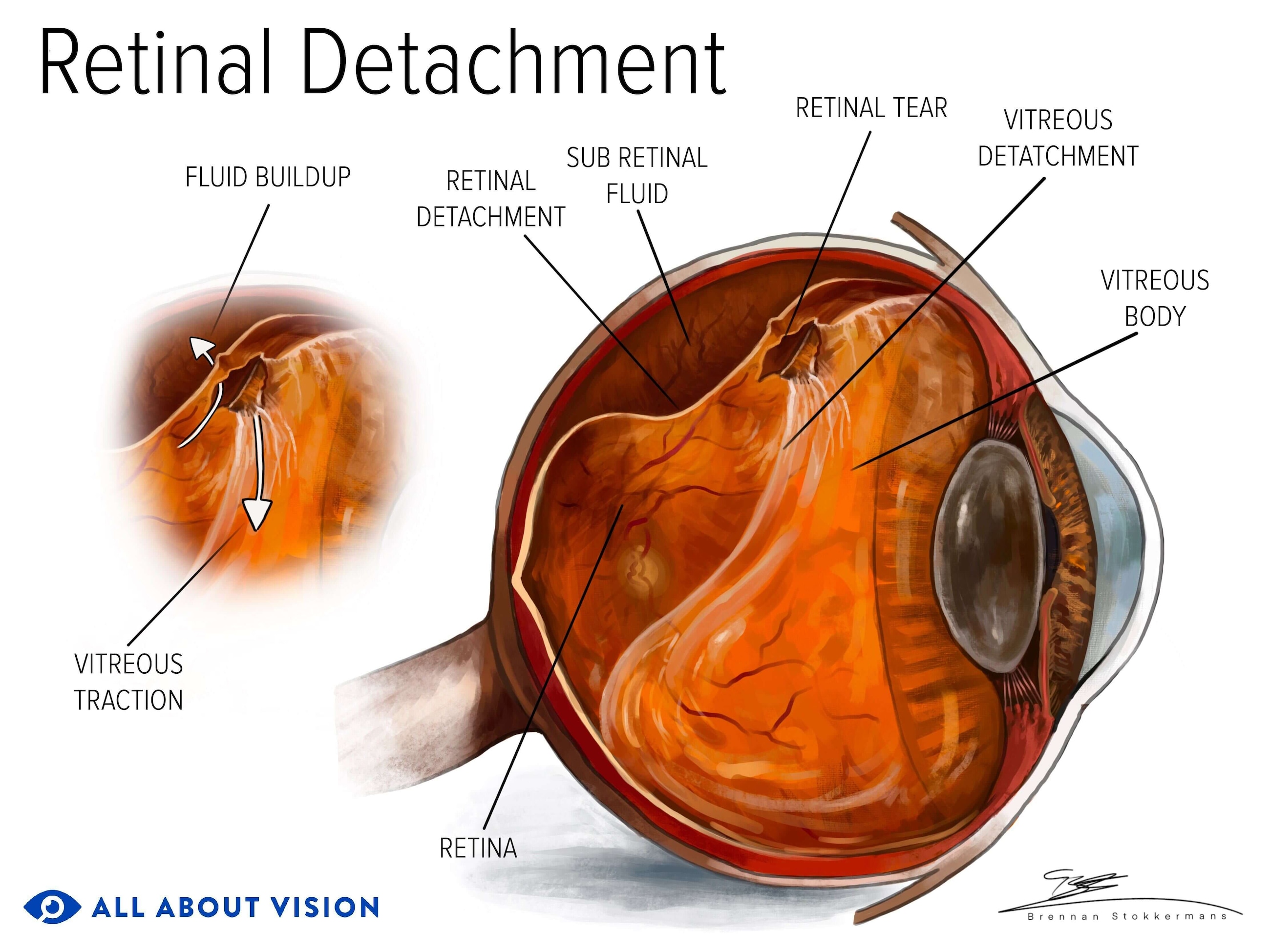 Retinal detachment