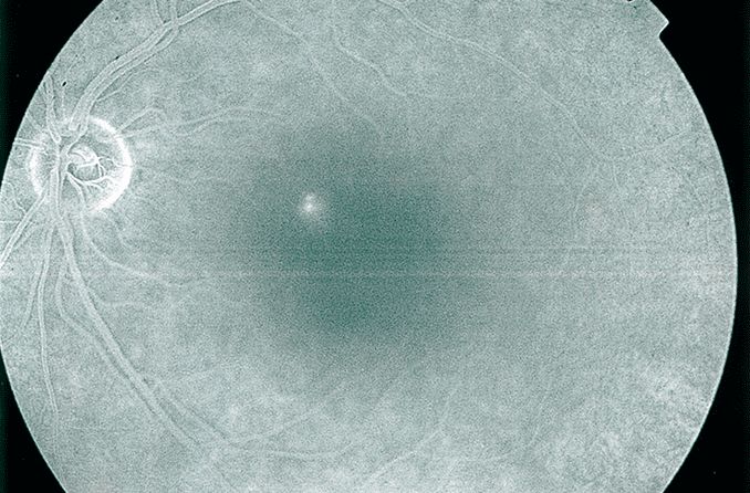 Central serous chorioretinopathy (central serous retinopathy) Central serous chorioretinopathy (central serous retinopathy)