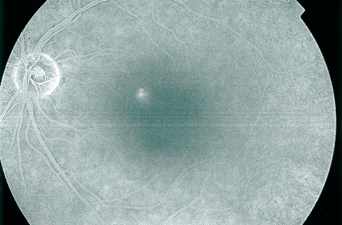 Central serous chorioretinopathy (central serous retinopathy)