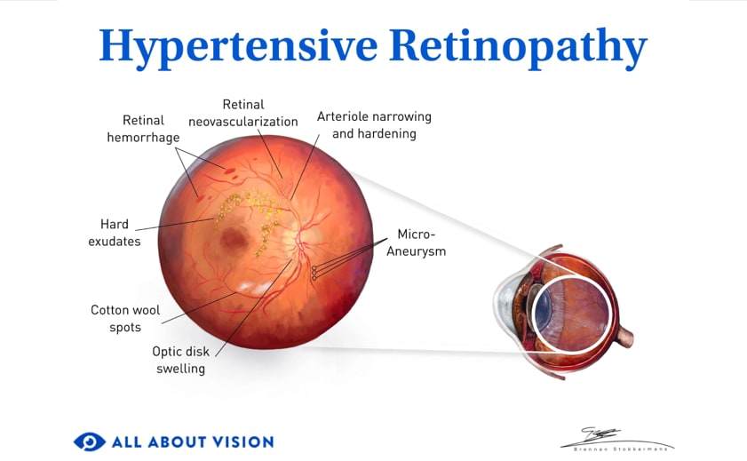 hypertensive retinopathy medical illustration.