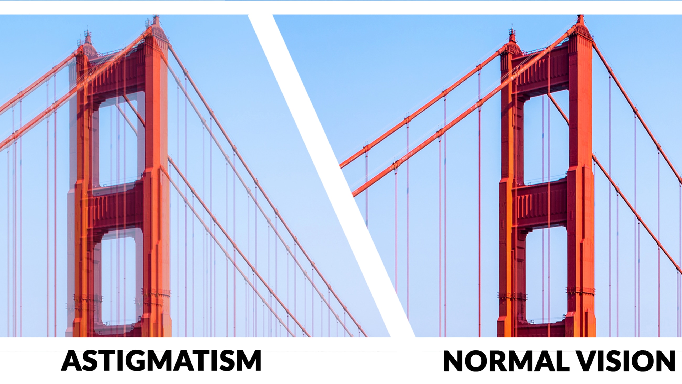Astigmatism