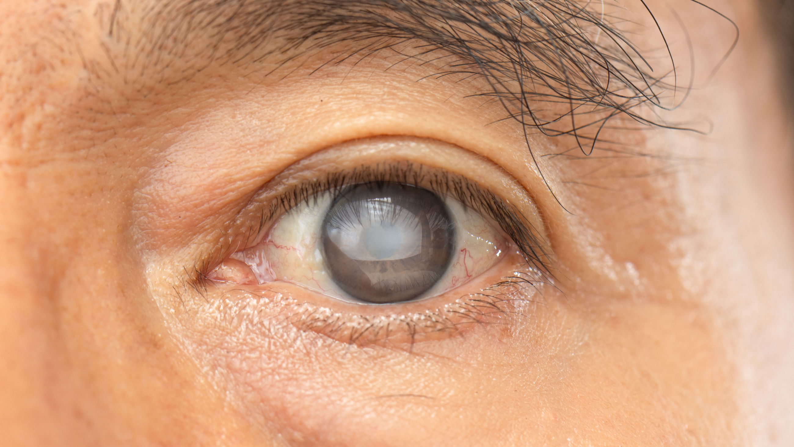 Close-up image of a man's eye with an untreated cataract.