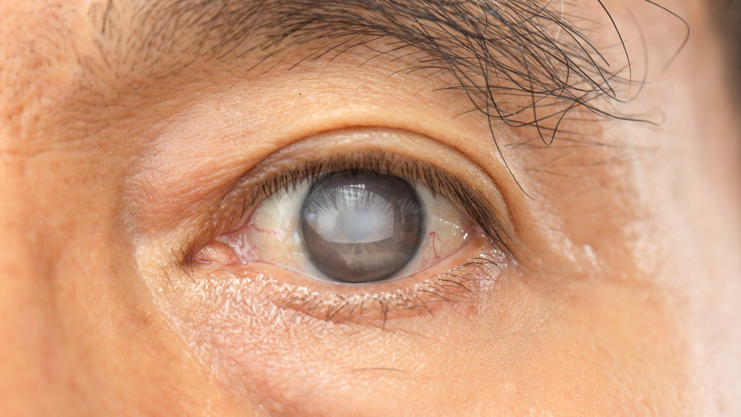 Close-up image of a man's eye with an untreated cataract.