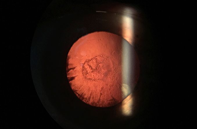 Posterior subcapsular cataract: Description and causes Posterior subcapsular cataract: Description and causes