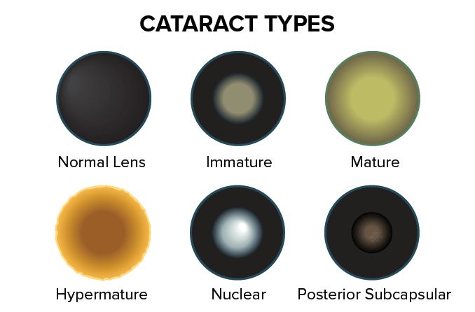 Are There More Than 3 Types of Cataracts?