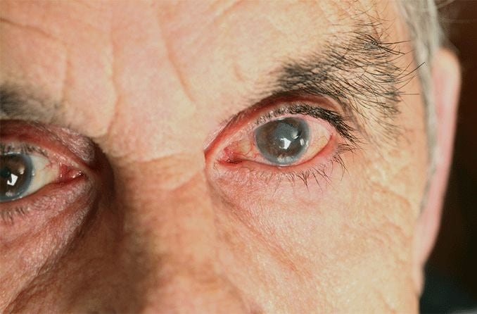 Cortical cataract: Description and causes