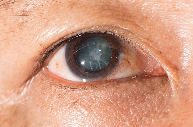 Traumatic cataracts: Causes, symptoms and treatment Traumatic cataracts: Causes, symptoms and treatment