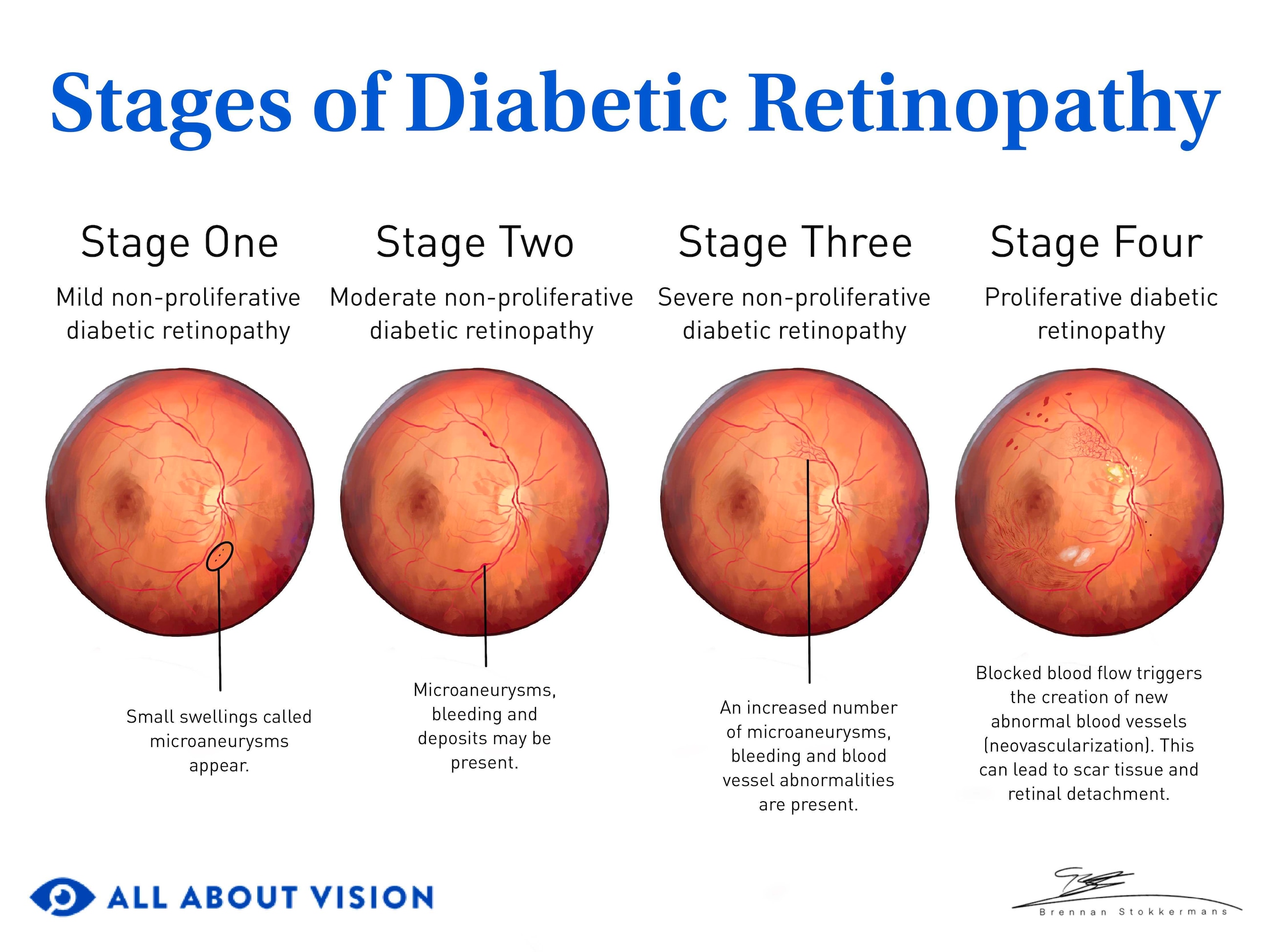 does semaglutide cause eye twitching Diabetes-Related Retinopathy: Causes, Treatment, Signs & Symptoms