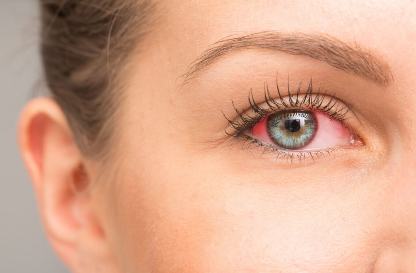 Dry eye treatment: How to soothe irritated eyes