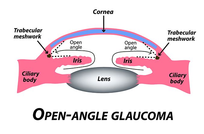 Open-angle glaucoma: Causes, symptoms and treatment