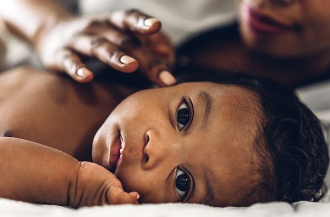 baby with congenital glaucoma