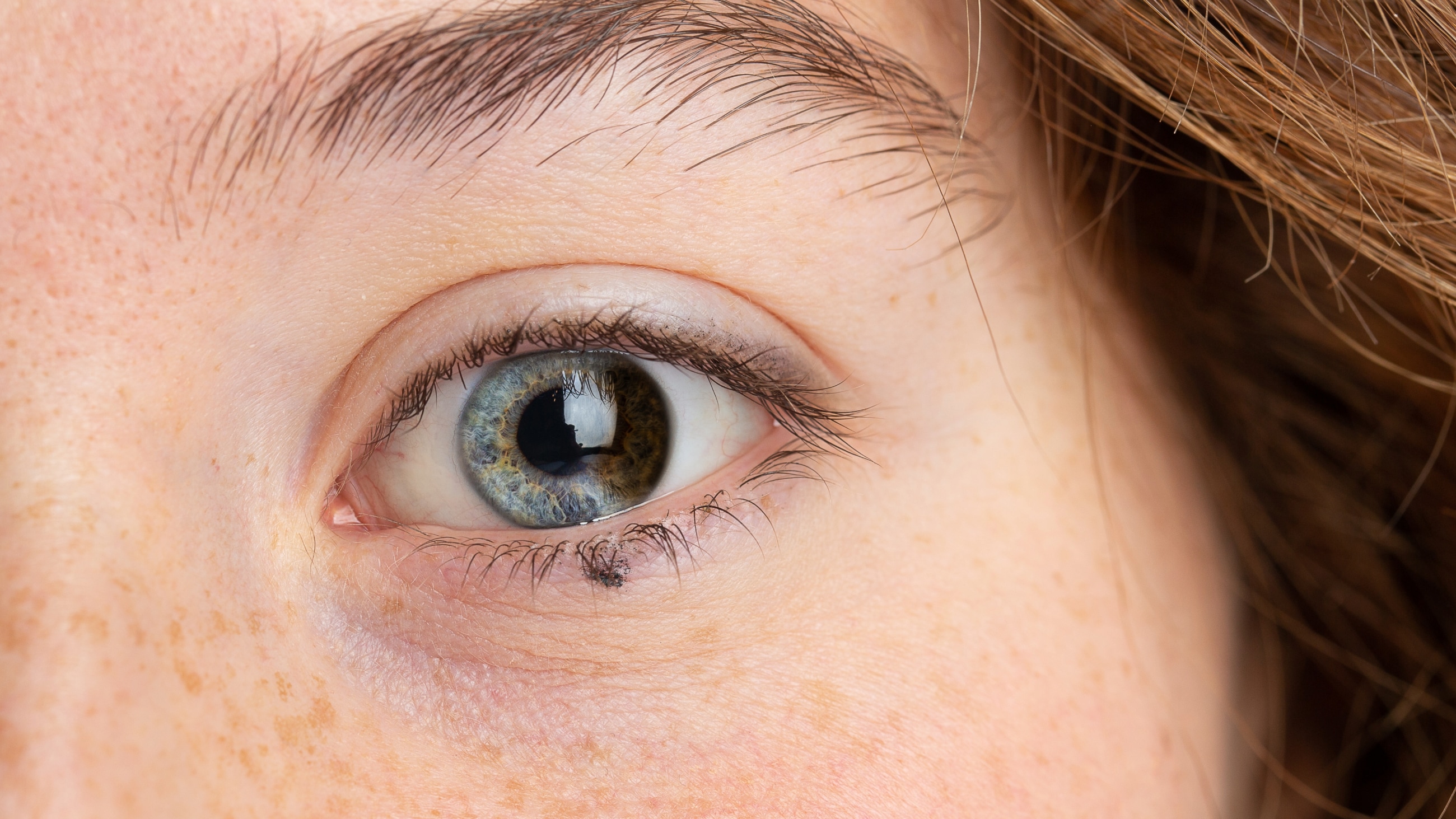 What is partial heterochromia? What is partial heterochromia?