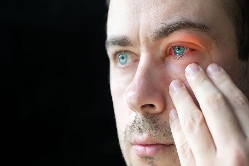 Red eyes and irritation can occur after a bug bite.
