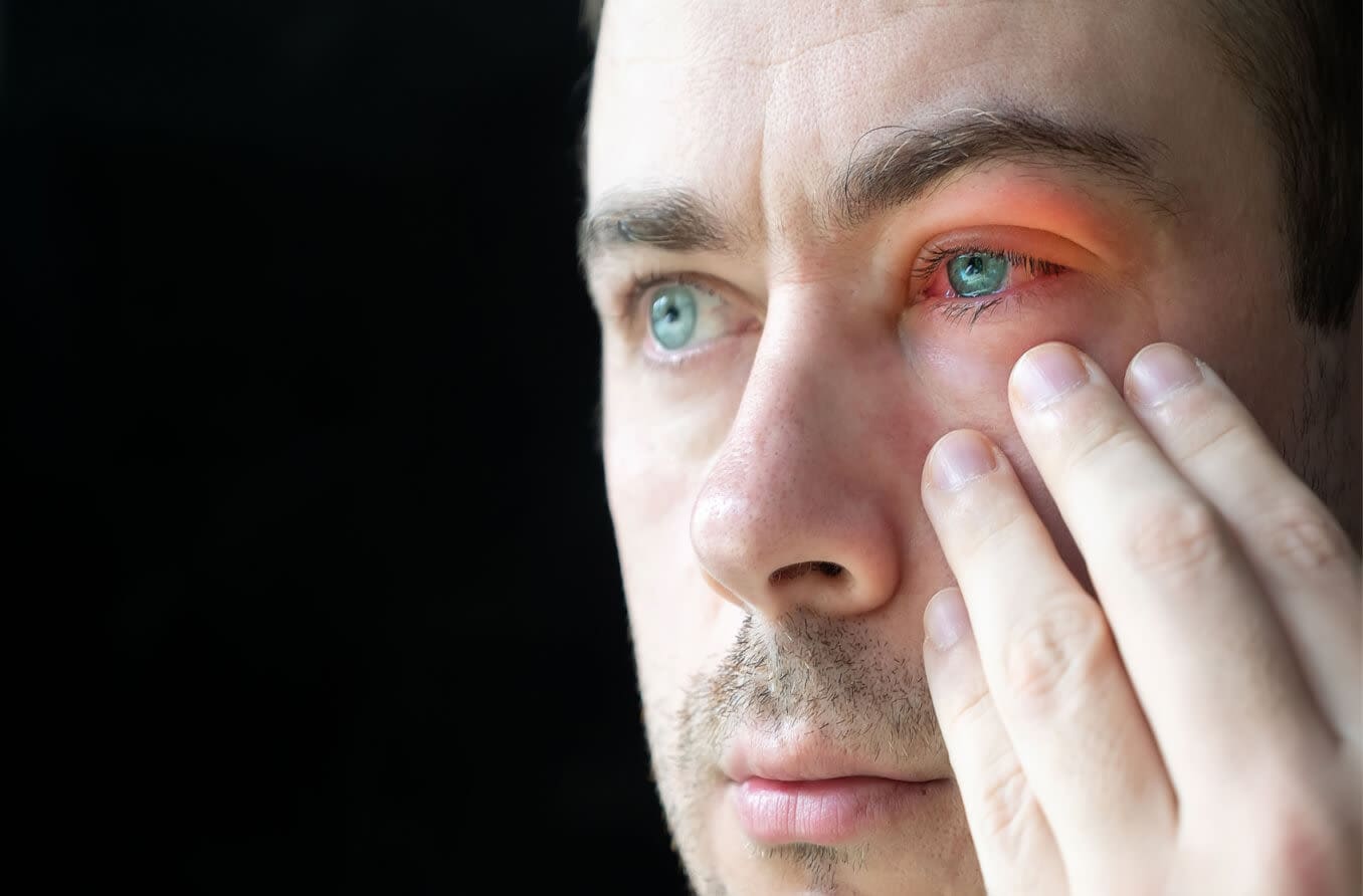 Types of bug bites on the eyelid