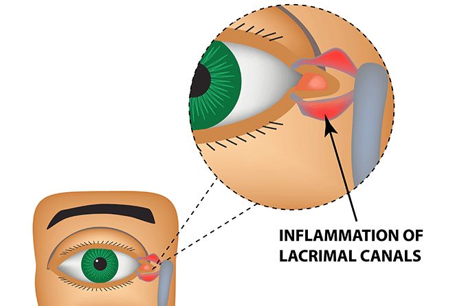 Canaliculitis: Causes, treatment and outcomes