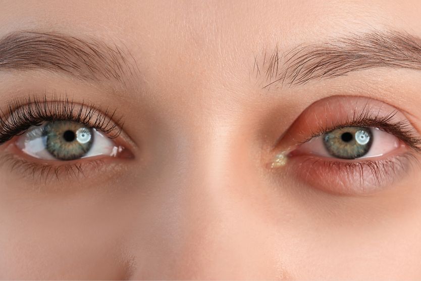 closeup of chemosis of the eye