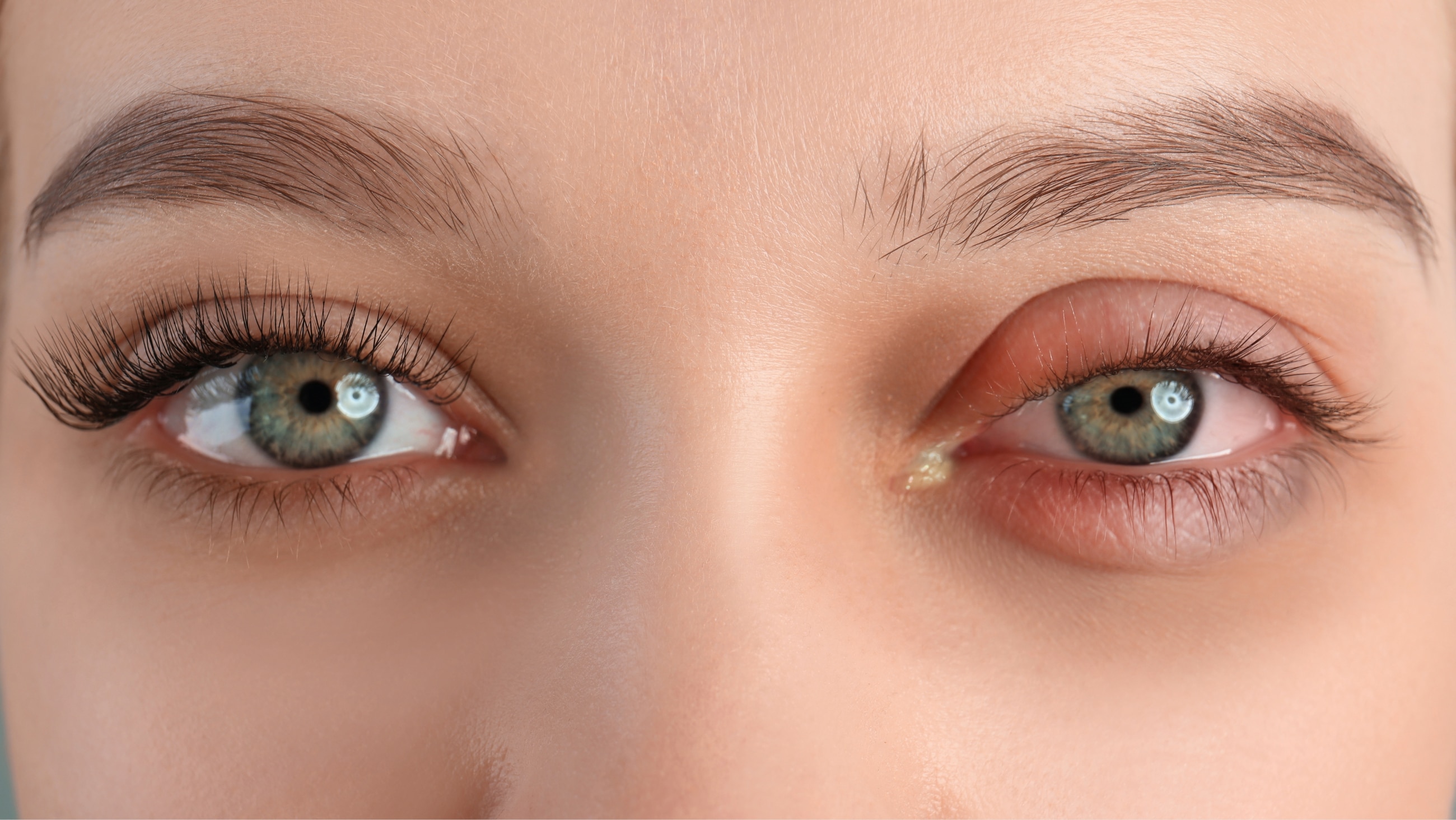 Chemosis: Causes, symptoms and treatment Chemosis: Causes, symptoms and treatment