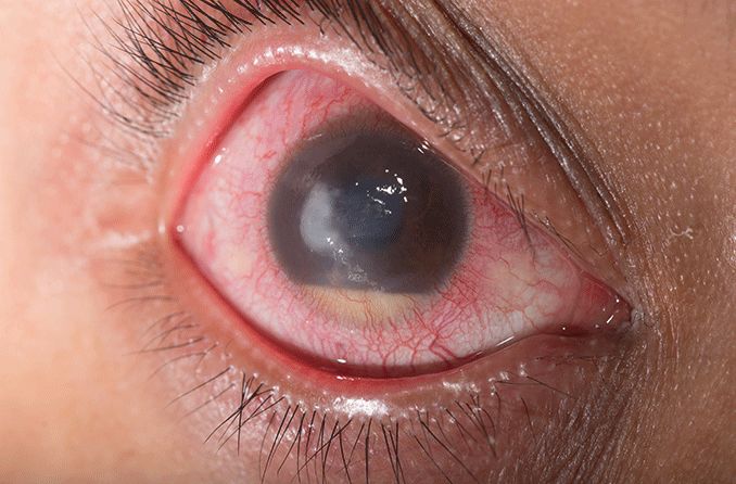 Endophthalmitis: Symptoms, causes and treatments Endophthalmitis: Symptoms, causes and treatments