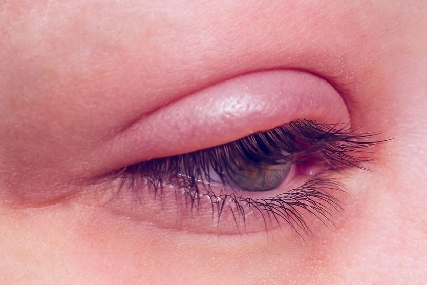 closeup of an eye infection