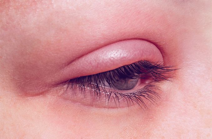 How to treat an eyelid infection