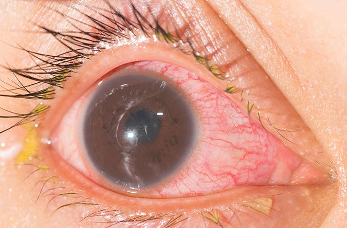 Iritis: Inflammation of the iris