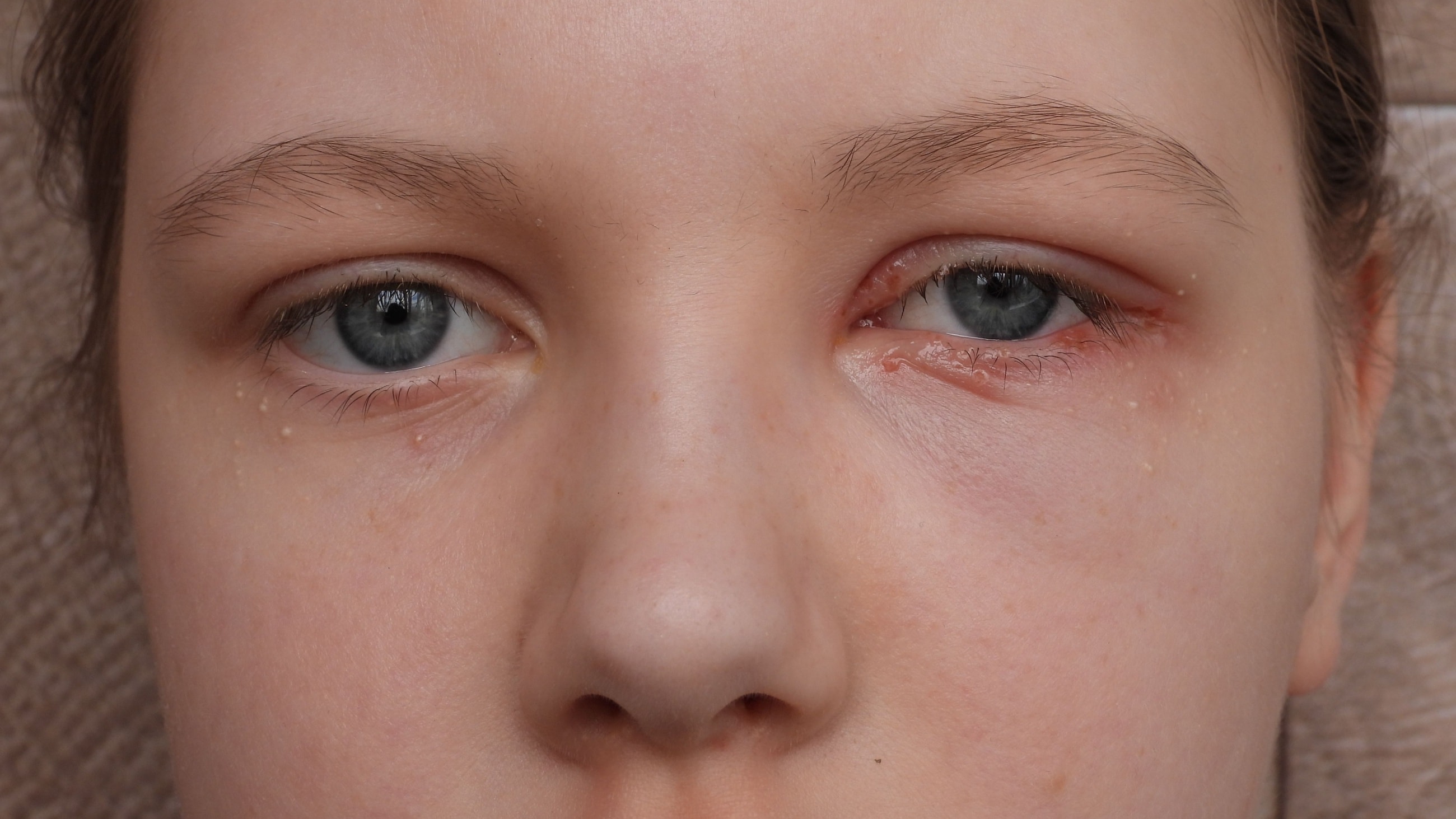 teen girl with ocular herpes