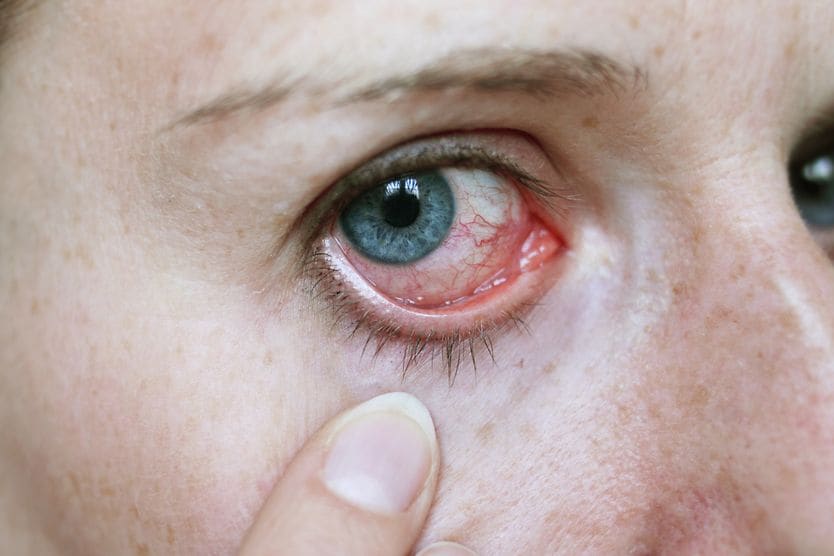 Girl pulls eyelid down to show red irritated eye