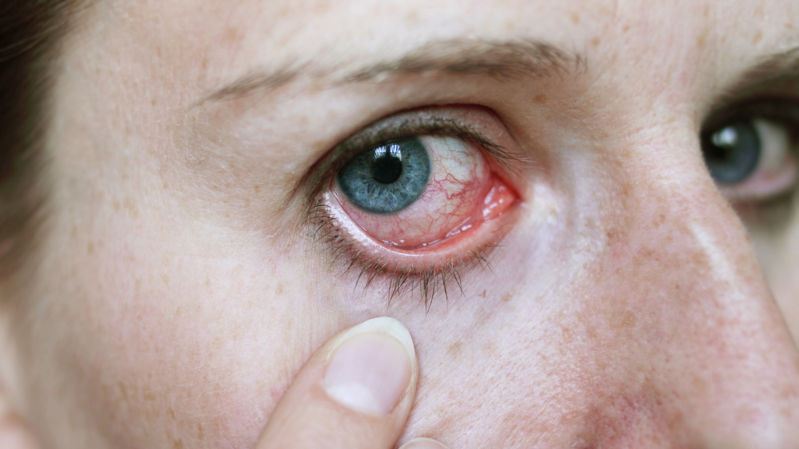 Uveitis, iritis and eye inflammation