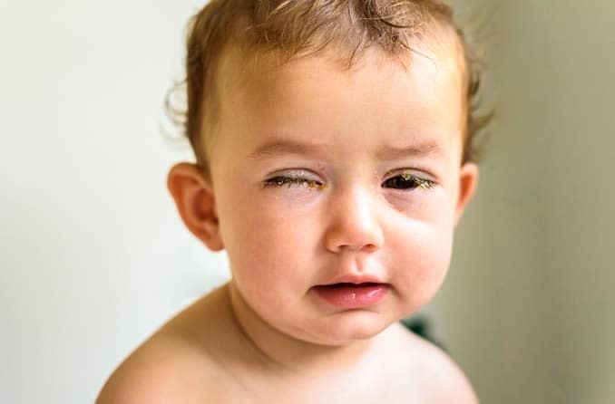 Identifying and treating pink eye in babies