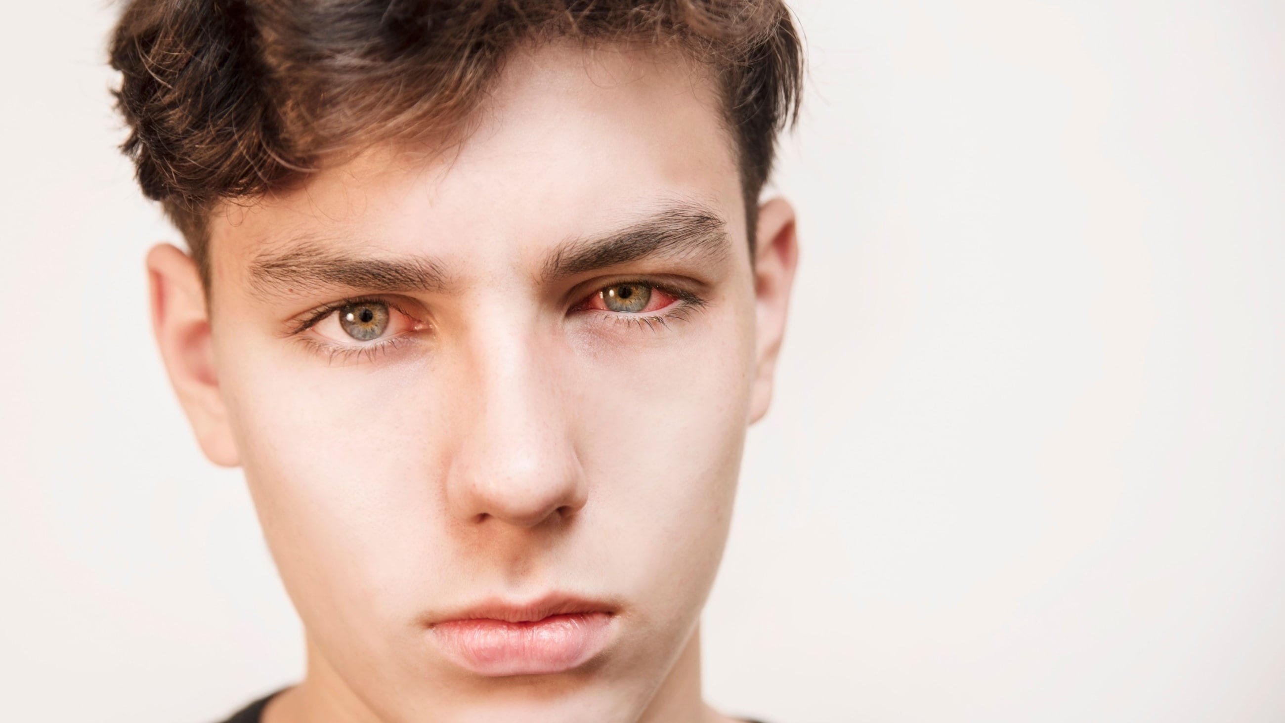 teen boy with chlamydial conjunctivitis teen boy with chlamydial conjunctivitis