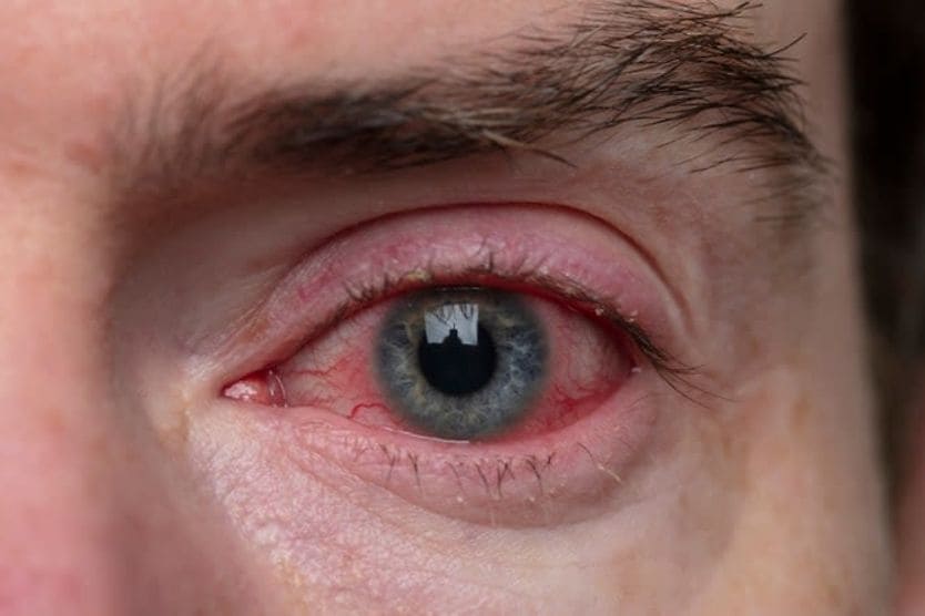 Close up of eye with conjunctivitis