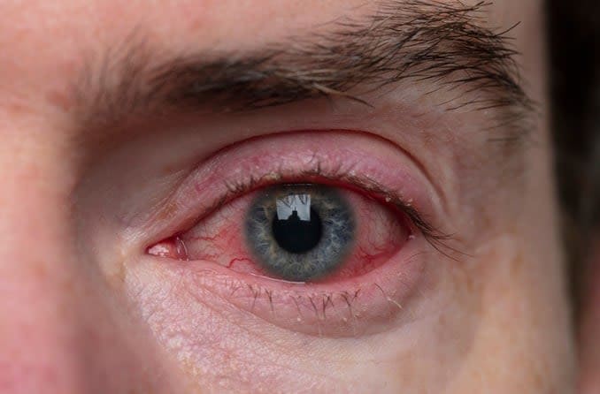 Chronic pink eye (chronic conjunctivitis) Chronic pink eye (chronic conjunctivitis)